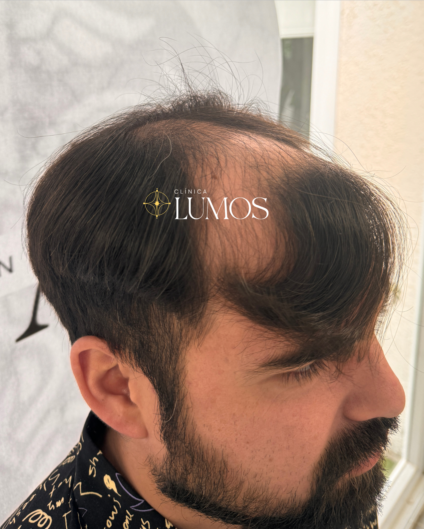 antes de nuestro paciente que sufre de alopecia,